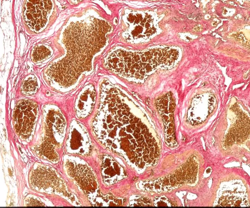 В сосудистых аномалиях мозга «виноваты» бактерии кишечника