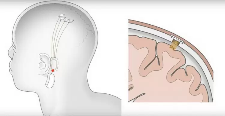 В августе Neuralink Илона Маска объявит о прогрессе подключения мозга к компьютеру