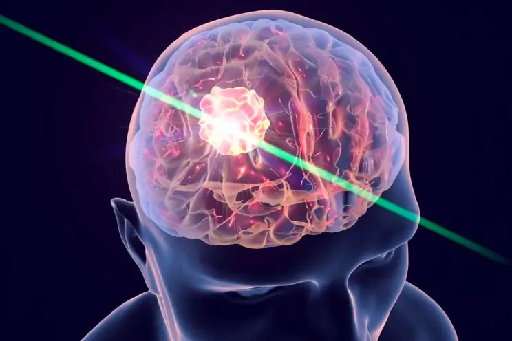 Ученые впервые вылечили рак мозга с помощью квантовой терапии