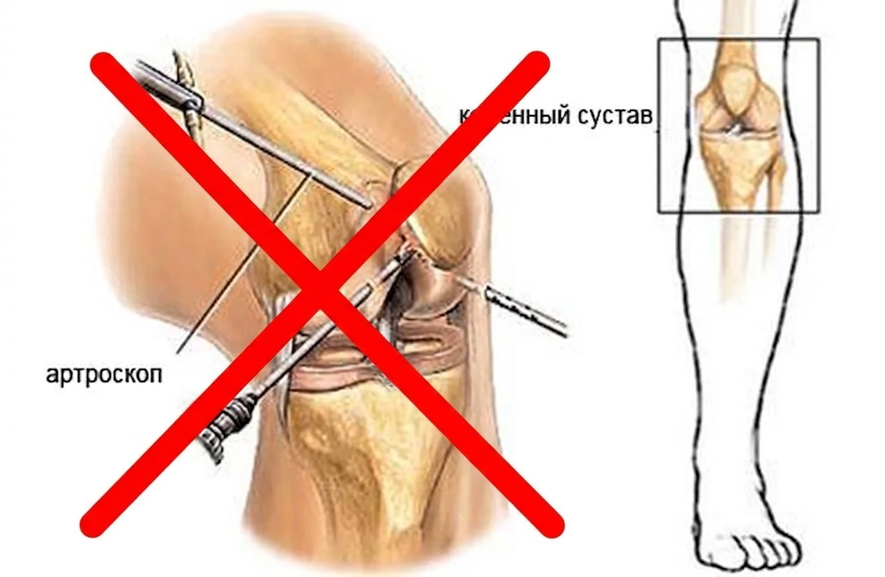 Одна из самых частых операций на колене не улучшает исходы при дегенеративных заболеваниях коленного сустава